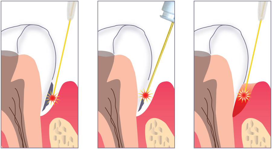 Behandlung von Parodontitis mit Laser